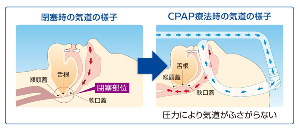 CPAP治療