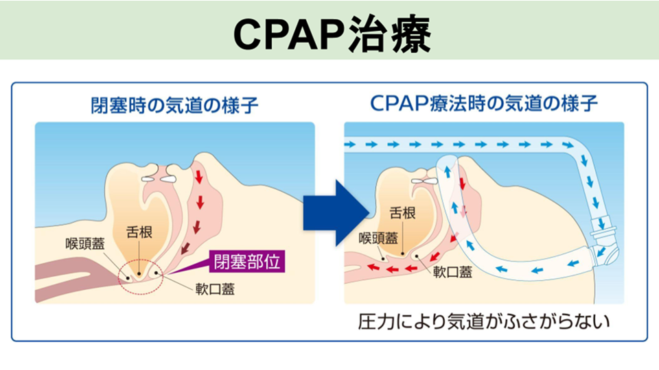 CPAP治療