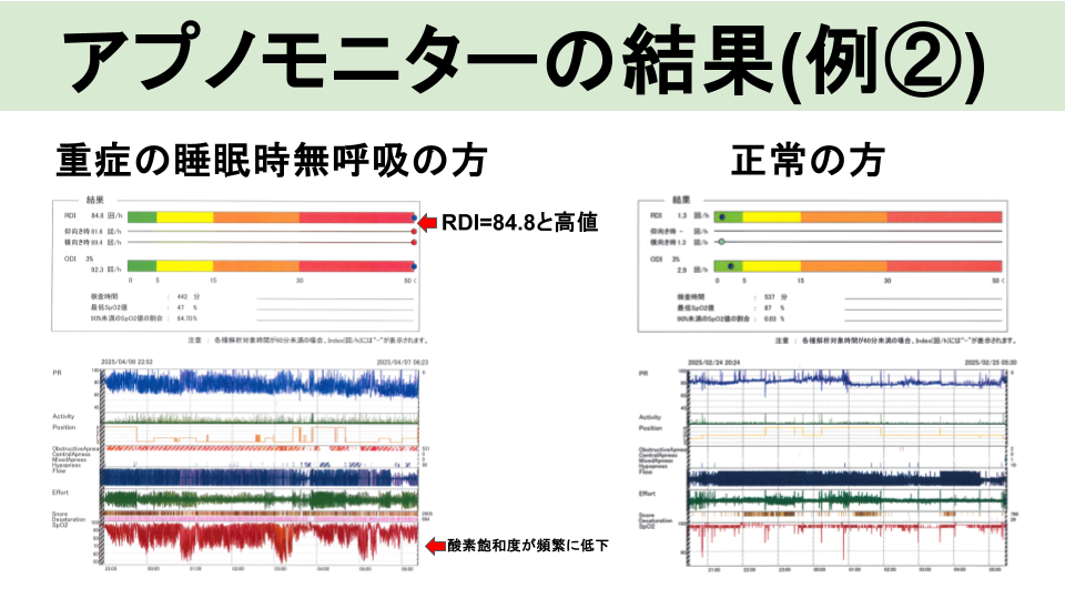 簡易アプノモニター検査