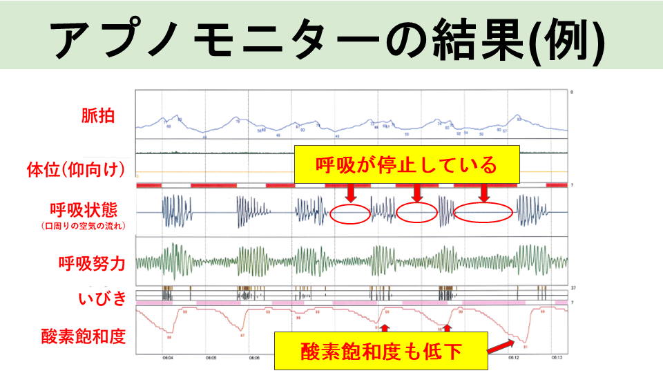 CPAP治療の実際