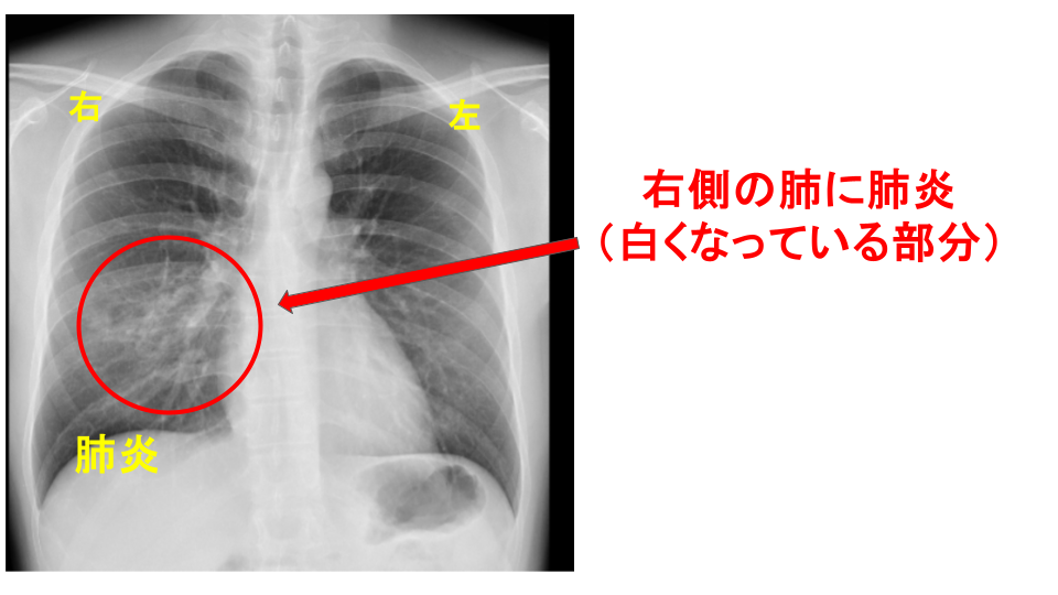 胸部レントゲン・CT検査