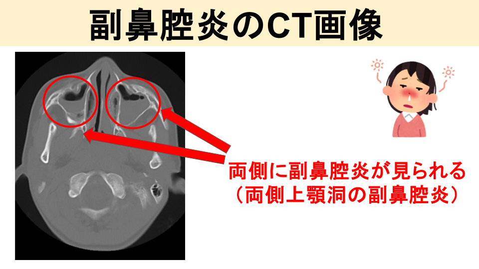 胸部X線やCT