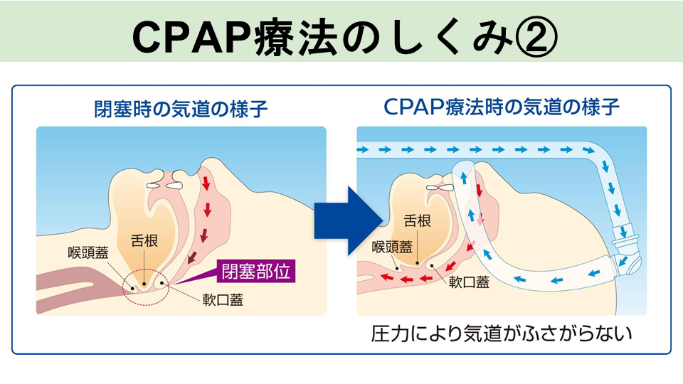 CPAP療法のしくみ