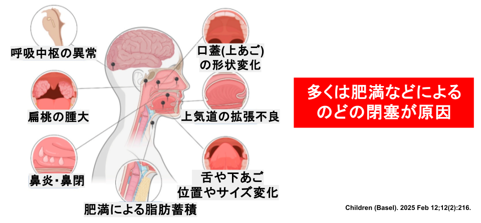 睡眠時無呼吸の原因