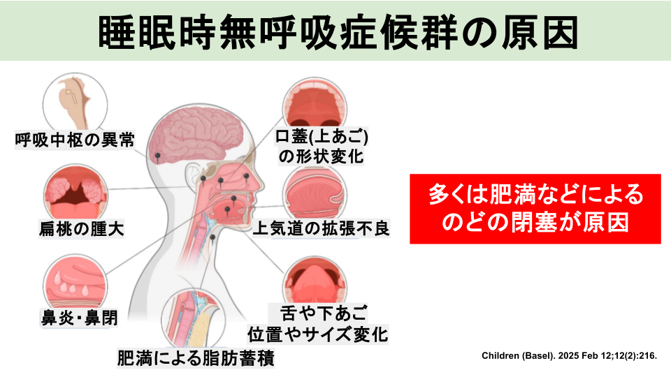 睡眠時無呼吸の原因