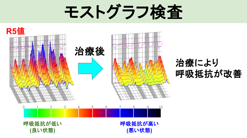 モストグラフ（広域周波オシレーション法）