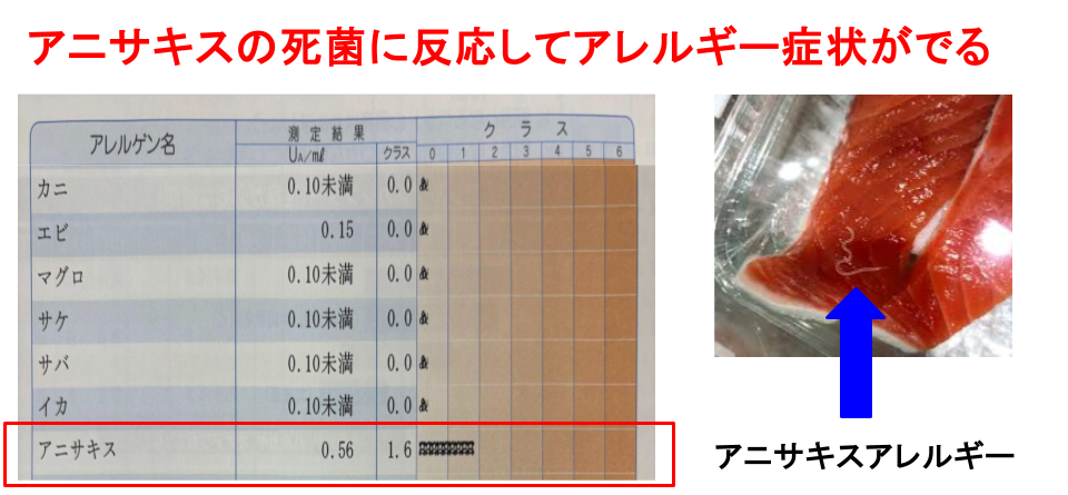 アニサキスアレルギー