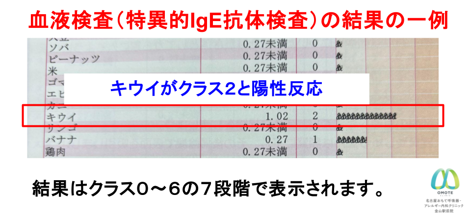 キウイアレルギー