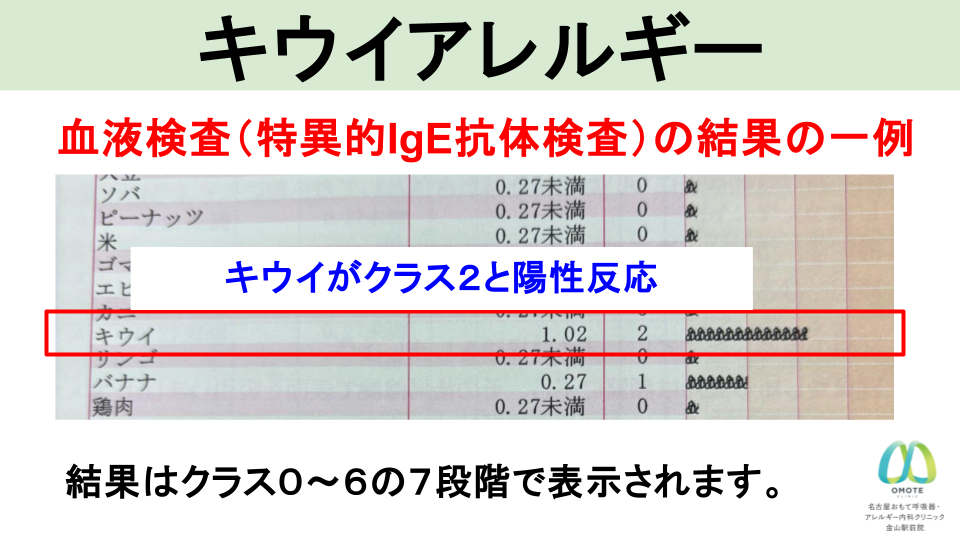 キウイアレルギー