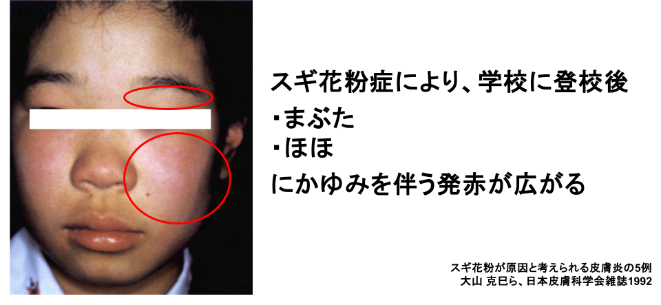 スギ花粉症で皮膚が赤くなったりするの?
