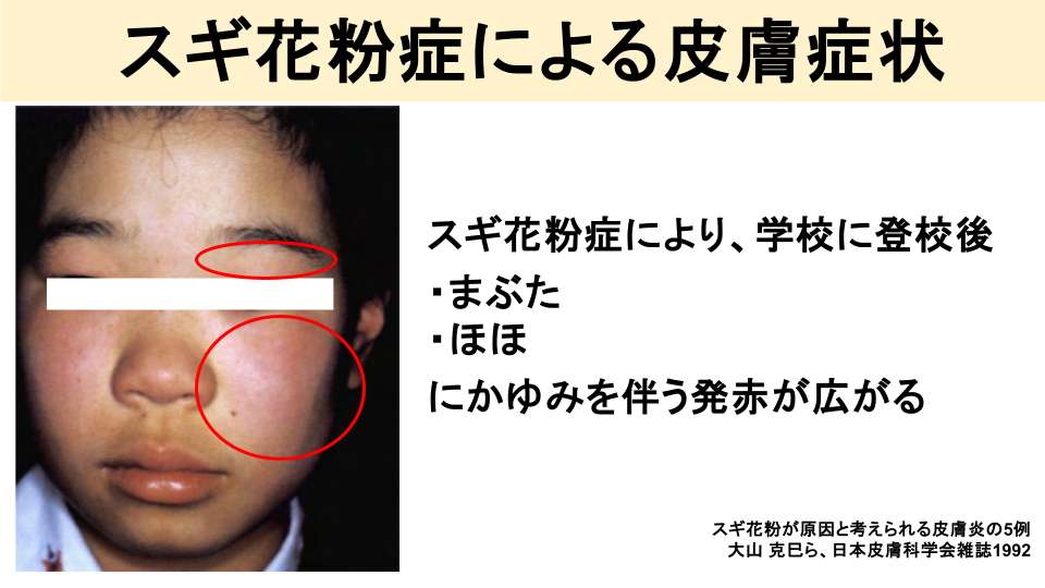 スギ花粉症で皮膚が赤くなったりするの？
