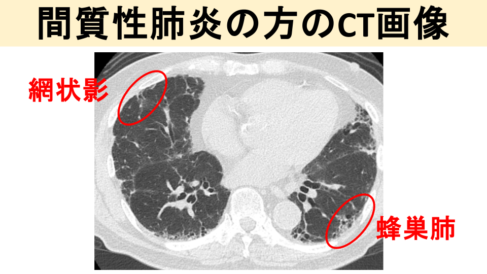 ②胸部レントゲン・CT検査