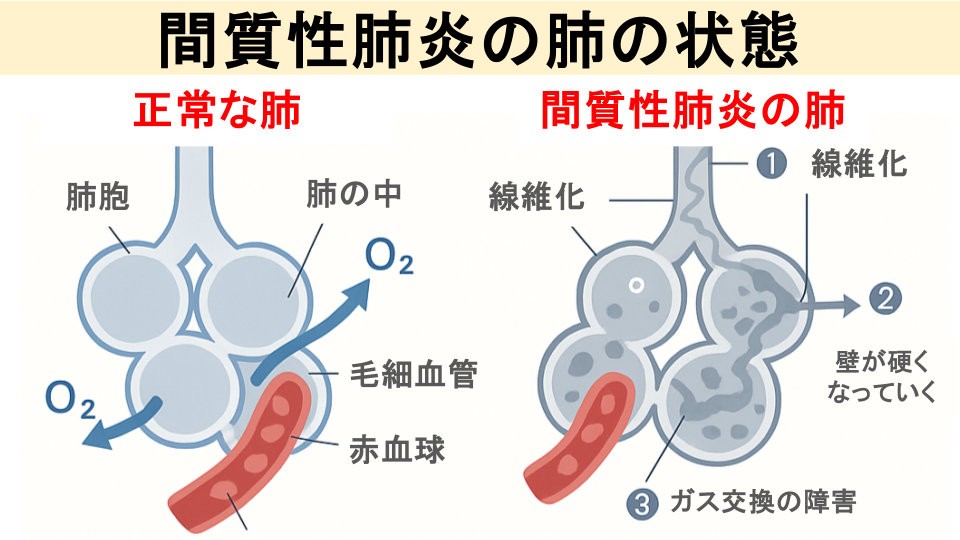 肺で何が起きている？