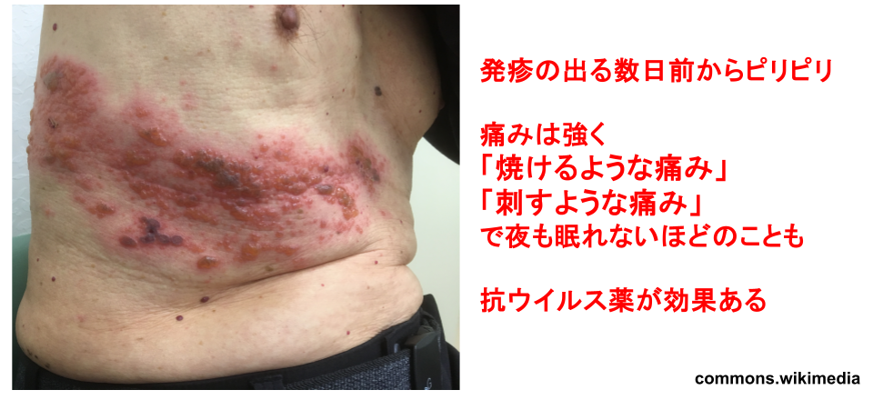 帯状疱疹