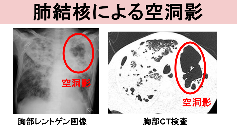 肺結核、非結核性抗酸菌症