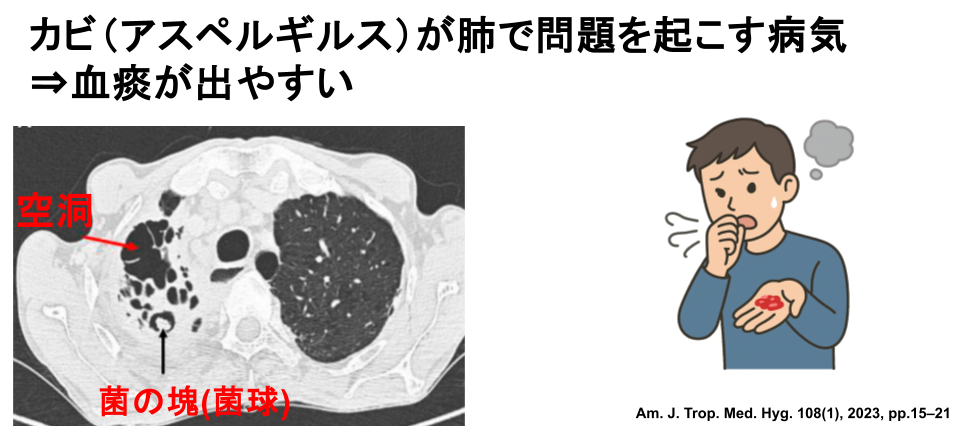肺アスペルギルス症