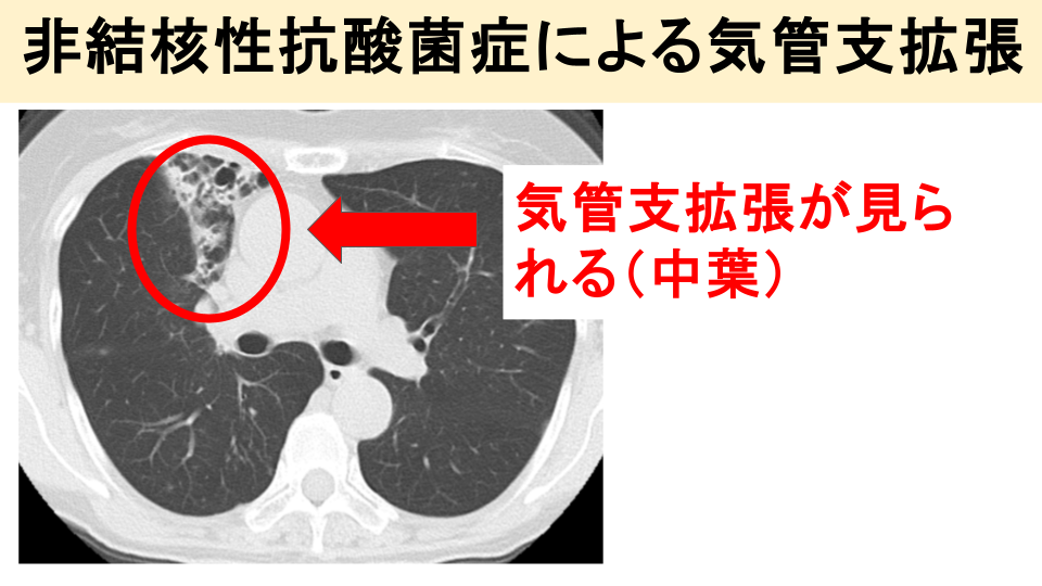 ①胸部レントゲン・胸部CT検査