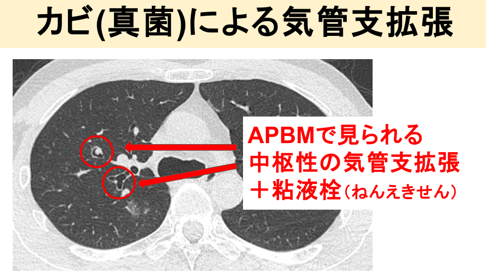 アレルギー性気管支肺真菌:ABPM