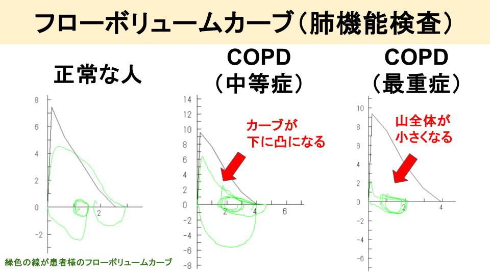 肺機能検査(スパイロメトリー)