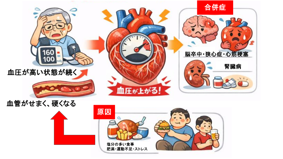 高血圧ってどんな病気?