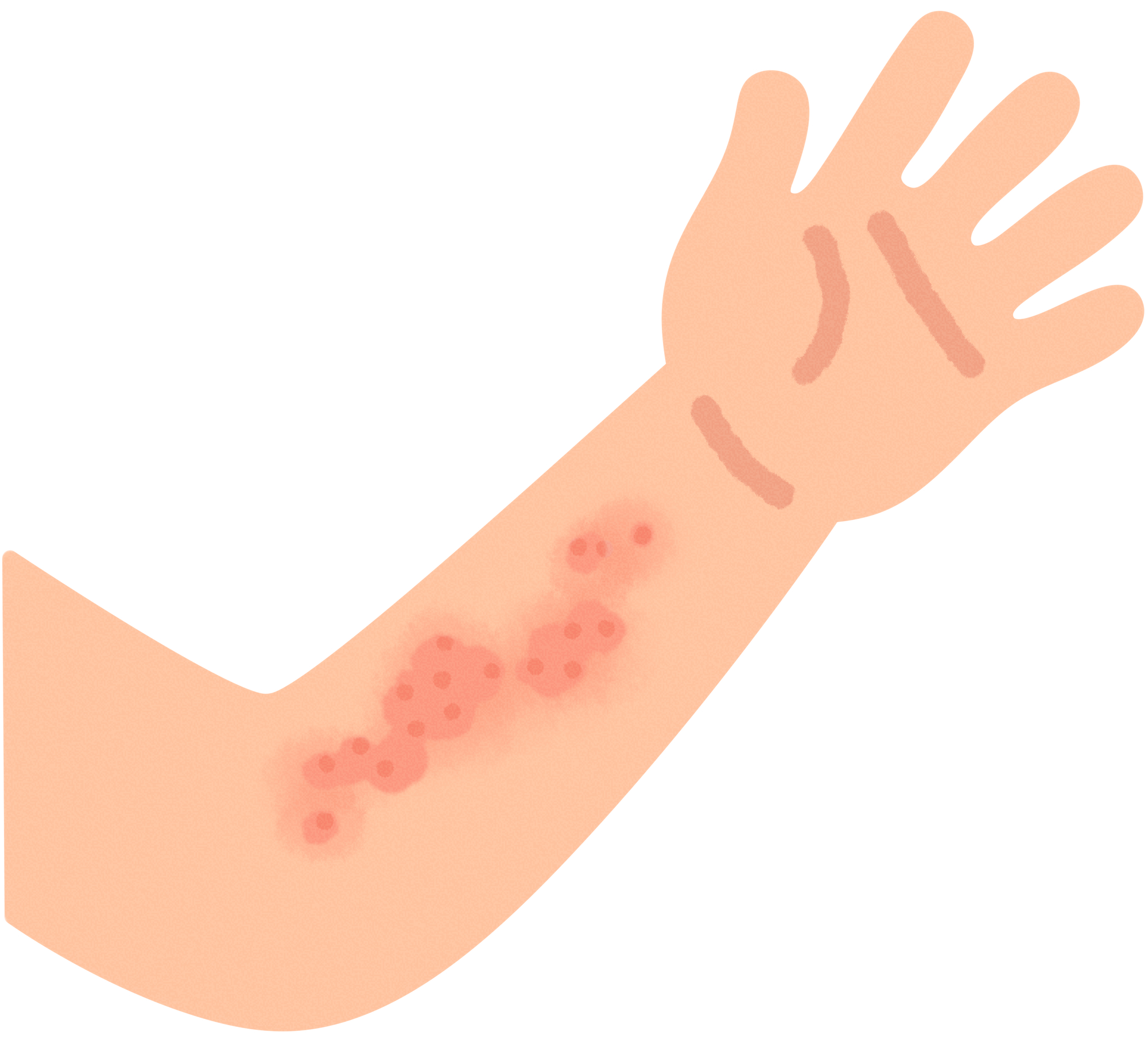 蕁麻疹（じんましん）