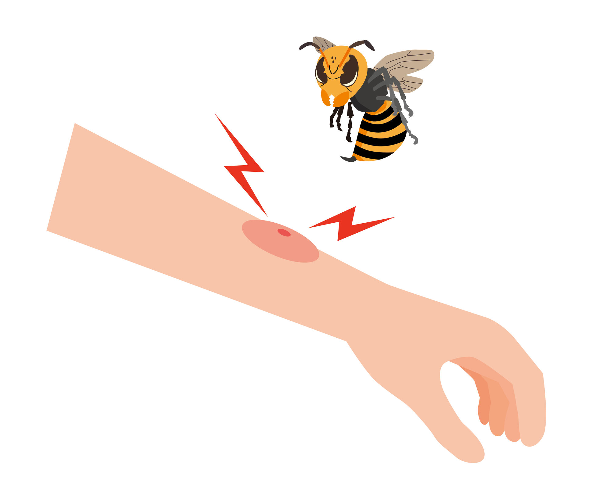 アナフィラキシー（エピペン処方）